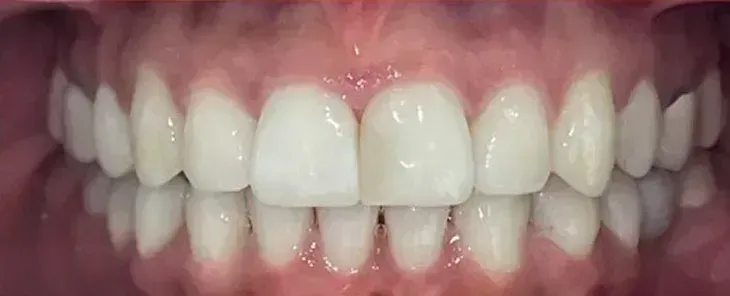 Second smile after treatment