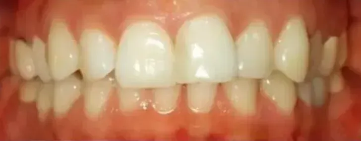 Second smile before treatment