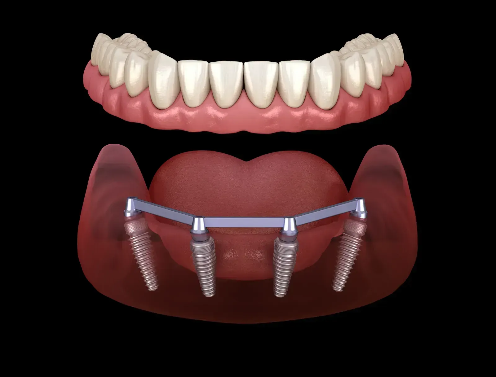 Dental implant model showing titanium post and crown restoration at Smiles of Niles dental clinic